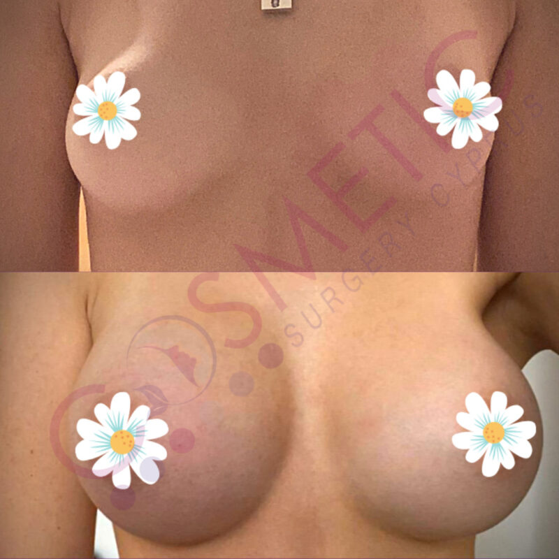 Boob Job Before and After Cosmetic Surgery Abroad