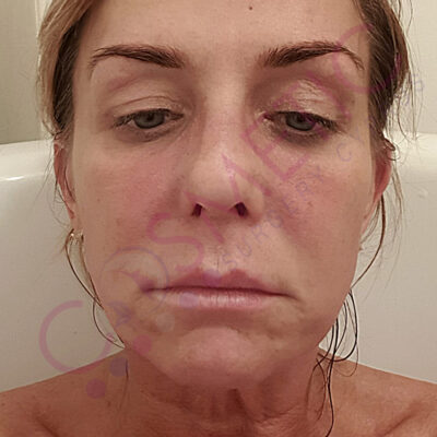 cosmetic surgery abroad facelift before