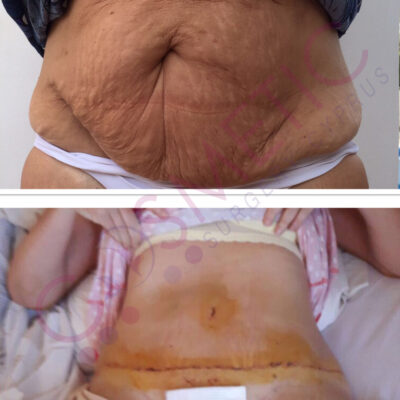 tummy tuck cosmetic surgery abroad