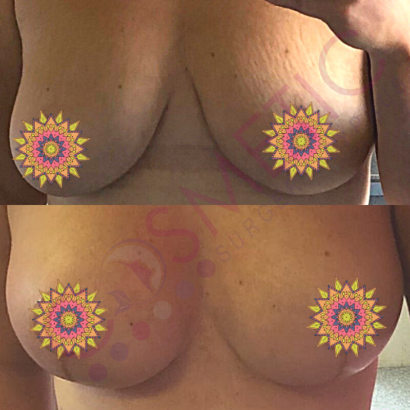Breast Lift and Implant Cosmetic Surgery Abroad