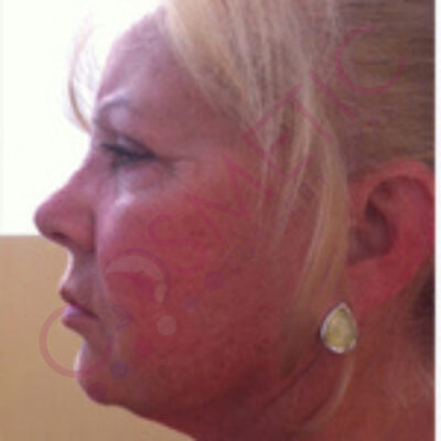 cosmetic surgery abroad facelift before
