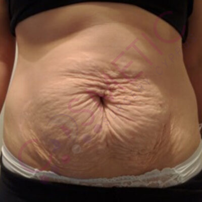 tummy tuck cosmetic surgery abroad