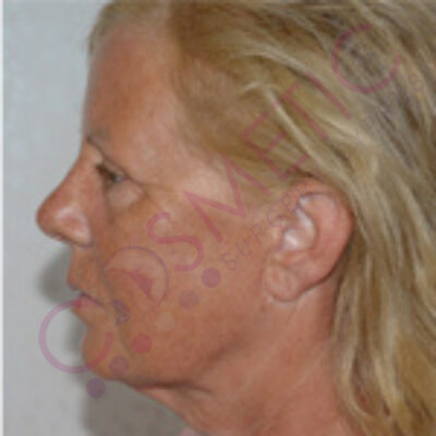 cosmetic surgery abroad facelift after