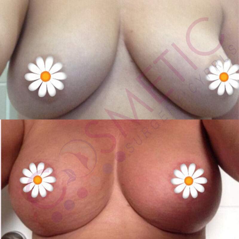 Breast Lift and Implant Cosmetic Surgery Abroad