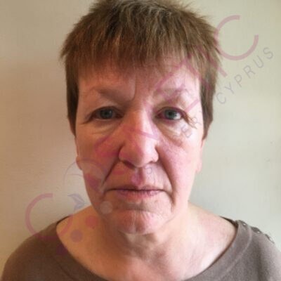 cosmetic surgery abroad facelift before