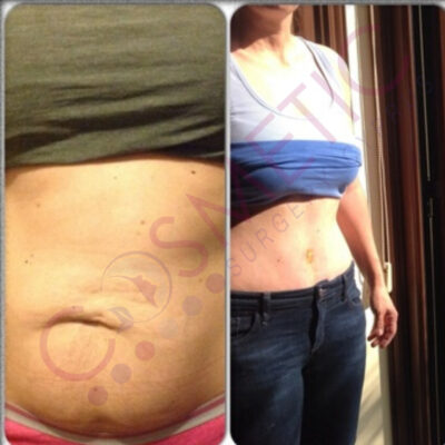 tummy tuck cosmetic surgery abroad