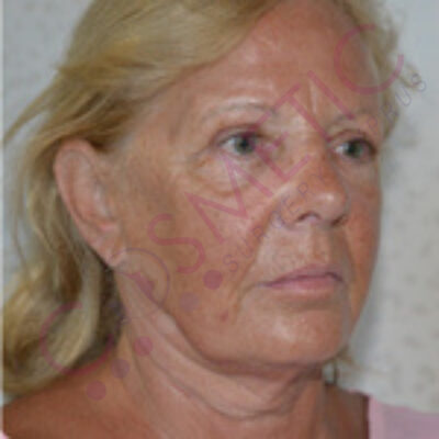 cosmetic surgery abroad facelift before