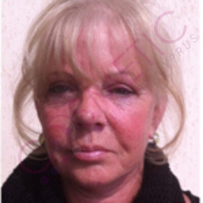 cosmetic surgery abroad facelift after