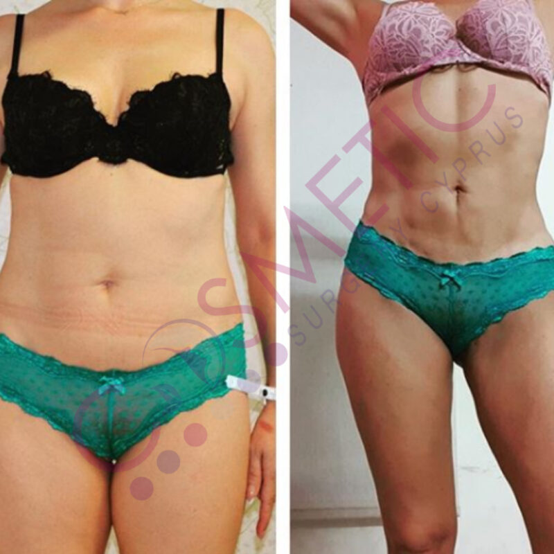 Vaser Liposuction Cosmetic Surgery Abroad