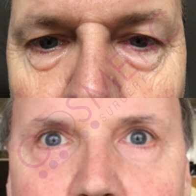 eyelid surgery abroad cyprus before