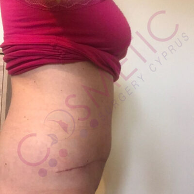 tummy tuck cosmetic surgery abroad