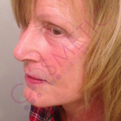 facelift result cosmetic surgery abroad