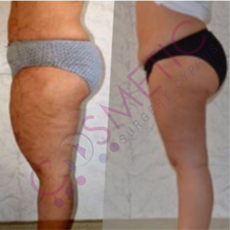 Vaser Liposuction Cosmetic Surgery Abroad