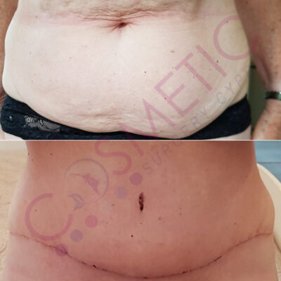 tummy tuck cosmetic surgery abroad