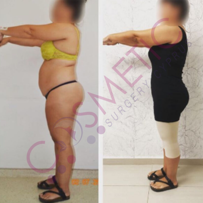 Vaser Liposuction Cosmetic Surgery Abroad