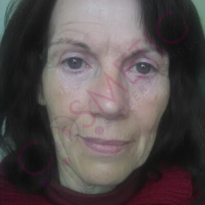 eyelid surgery abroad cyprus after