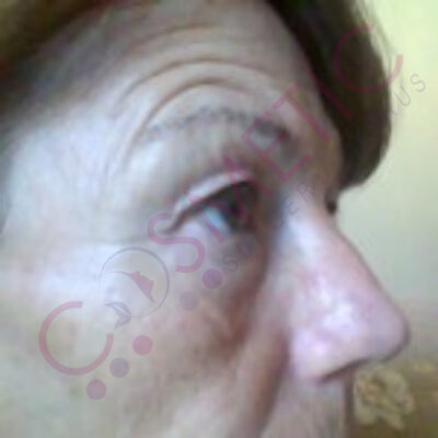eyelid surgery abroad cyprus before