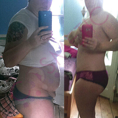 mini tummy tuck cosmetic surgery abroad