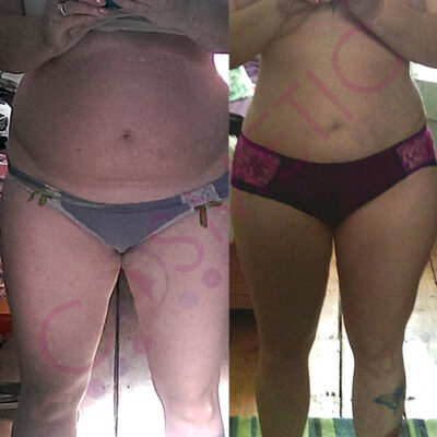 mini tummy tuck cosmetic surgery abroad
