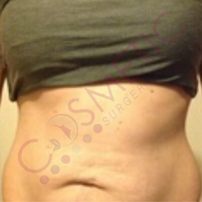 tummy tuck cosmetic surgery abroad