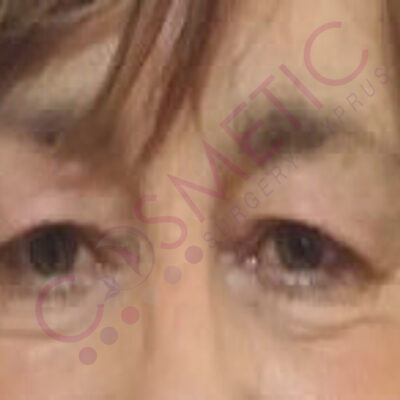 eyelid surgery abroad cyprus before