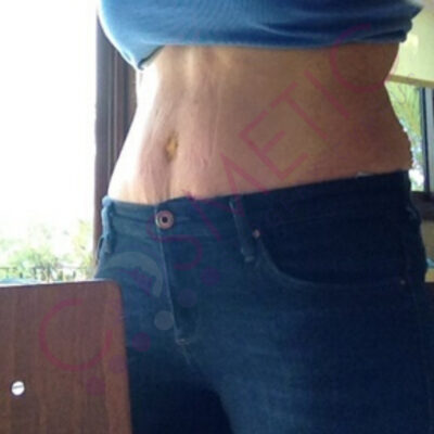 tummy tuck cosmetic surgery abroad