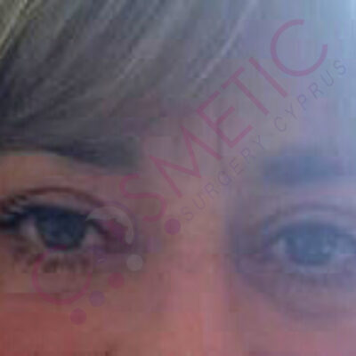 eyelid surgery abroad cyprus after