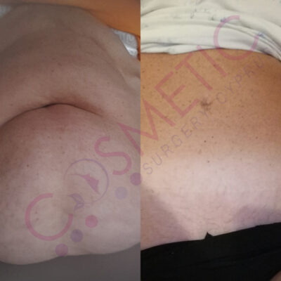 tummy tuck cosmetic surgery abroad