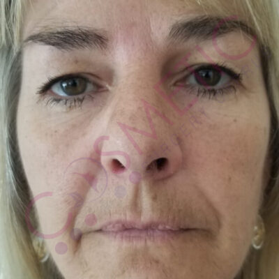 Cosmetic surgery abroad upper blepharoplasty eyelid