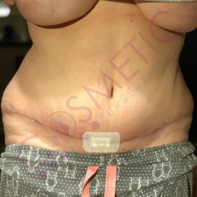 tummy tuck cosmetic surgery abroad