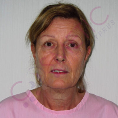 facelift result cosmetic surgery abroad