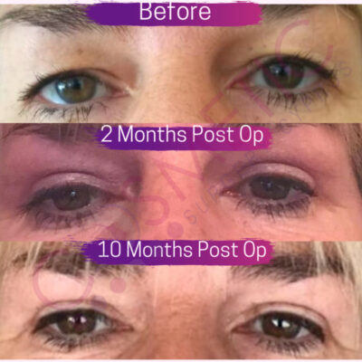 Cosmetic surgery abroad upper blepharoplasty eyelid