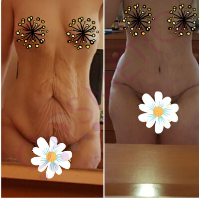 tummy tuck cosmetic surgery abroad