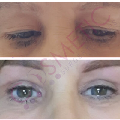 Cosmetic surgery abroad upper blepharoplasty eyelid