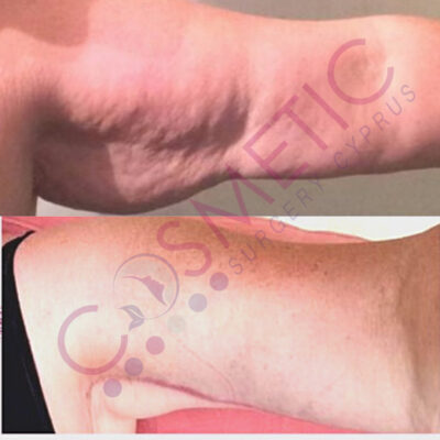 Arm Lift Before and After Cosmetic Surgery Abroad