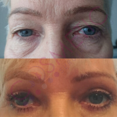 Cosmetic surgery abroad upper blepharoplasty eyelid