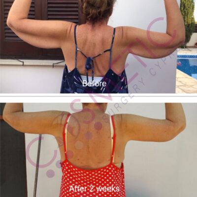 Arm Lift Before and After Cosmetic Surgery Abroad