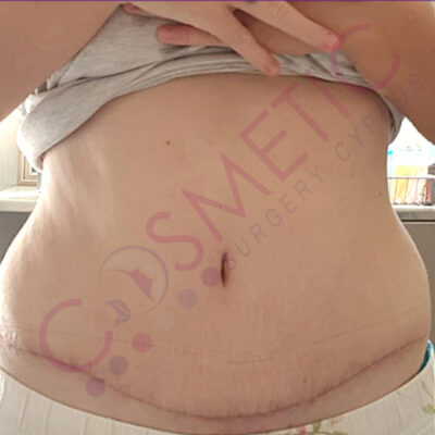 tummy tuck cosmetic surgery abroad