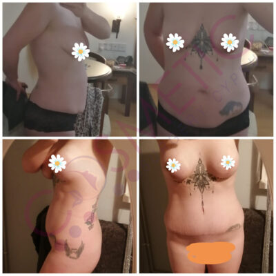 tummy tuck cosmetic surgery abroad