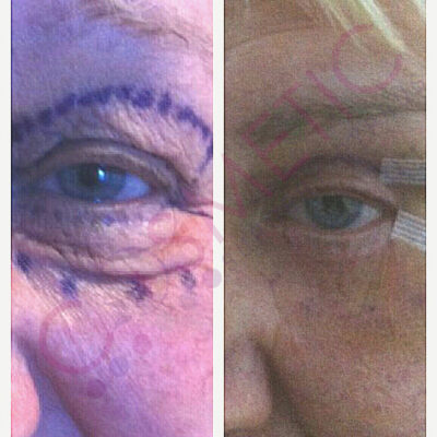 Cosmetic surgery abroad upper blepharoplasty eyelid