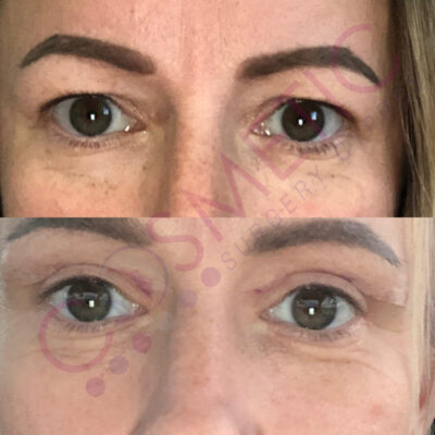 Cosmetic surgery abroad upper blepharoplasty eyelid