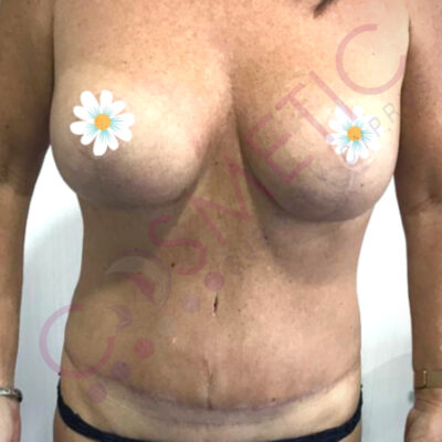 tummy tuck cosmetic surgery abroad