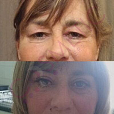 Cosmetic surgery abroad upper blepharoplasty eyelid