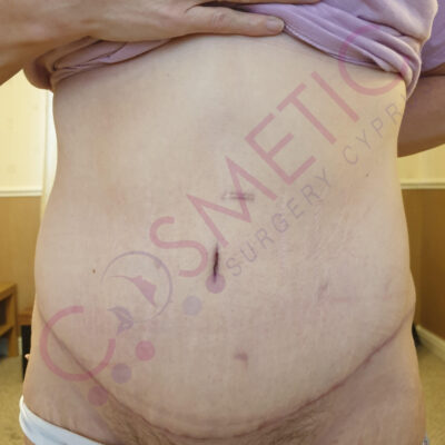 tummy tuck cosmetic surgery abroad