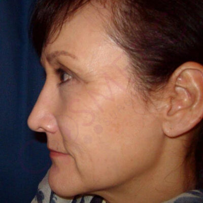 rhinoplasty nose job cosmetic surgery abroad