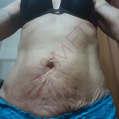 mini tummy tuck cosmetic surgery abroad
