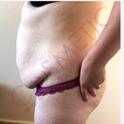 tummy tuck cosmetic surgery abroad