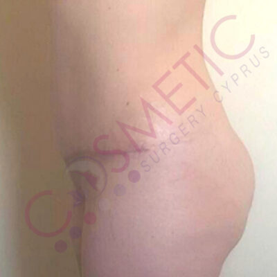 tummy tuck cosmetic surgery abroad