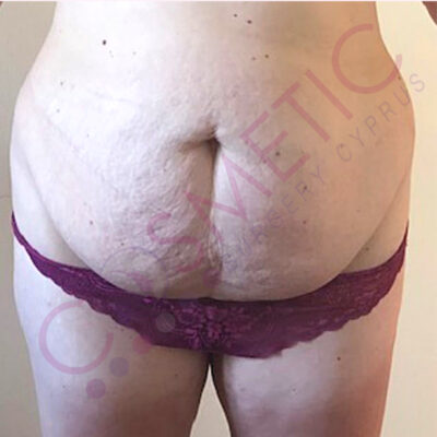 tummy tuck cosmetic surgery abroad