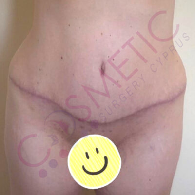 tummy tuck cosmetic surgery abroad